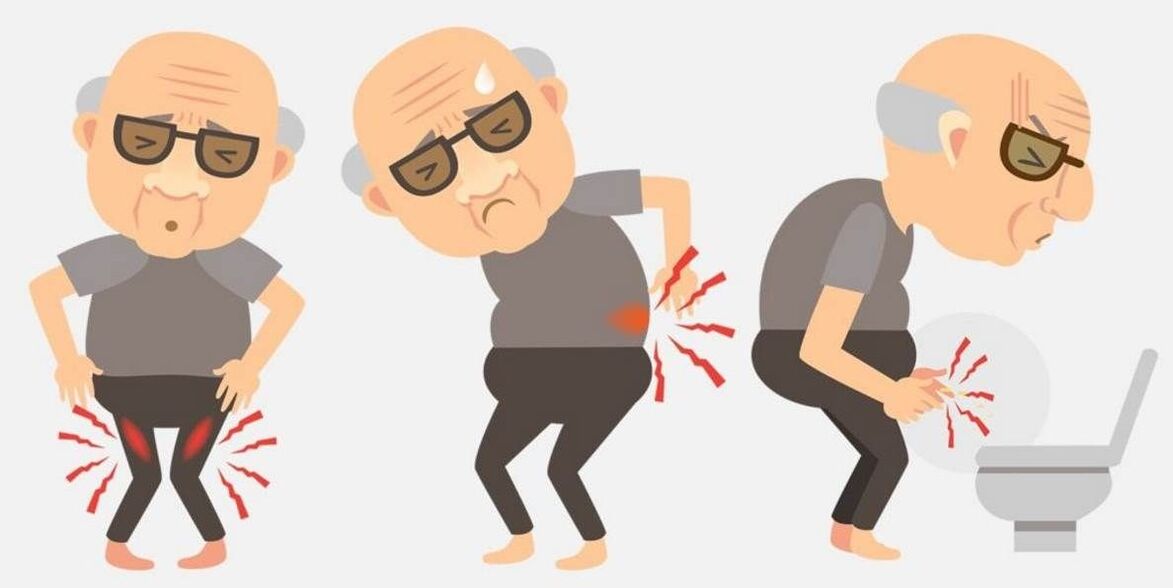 prosztatagyulladás tünetei